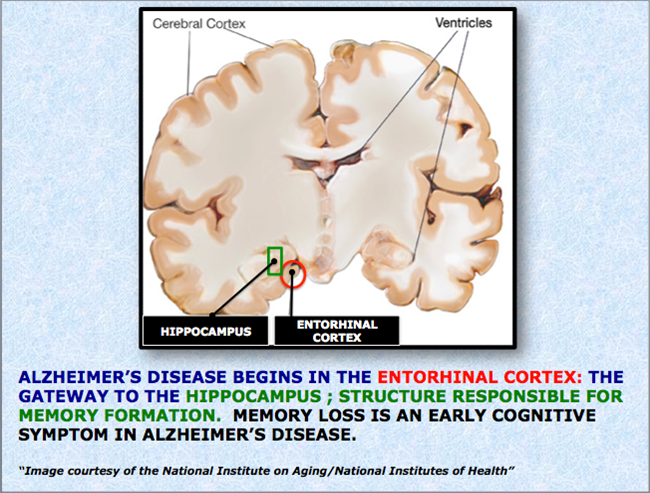 alzheimer-brain-structure