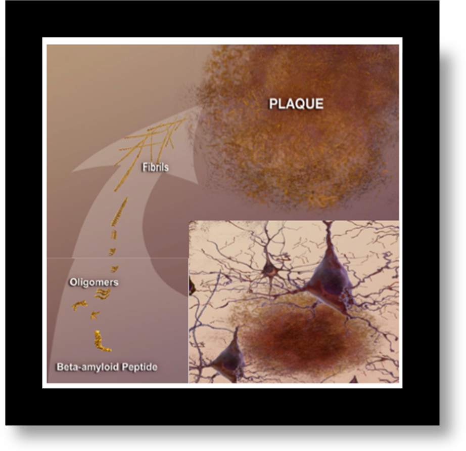 amyloid-plaques