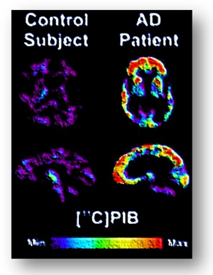 brain-PET-scan
